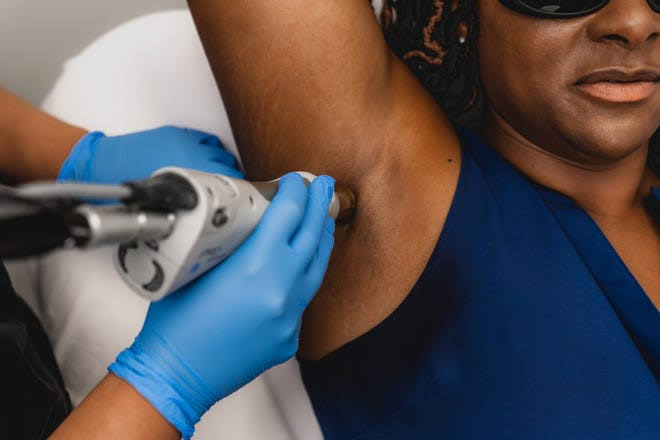 Nd:YAG laser hair removal on the underarm of a client with a deeper Fitzpatrick skin tone at Vale Laser Aesthetics