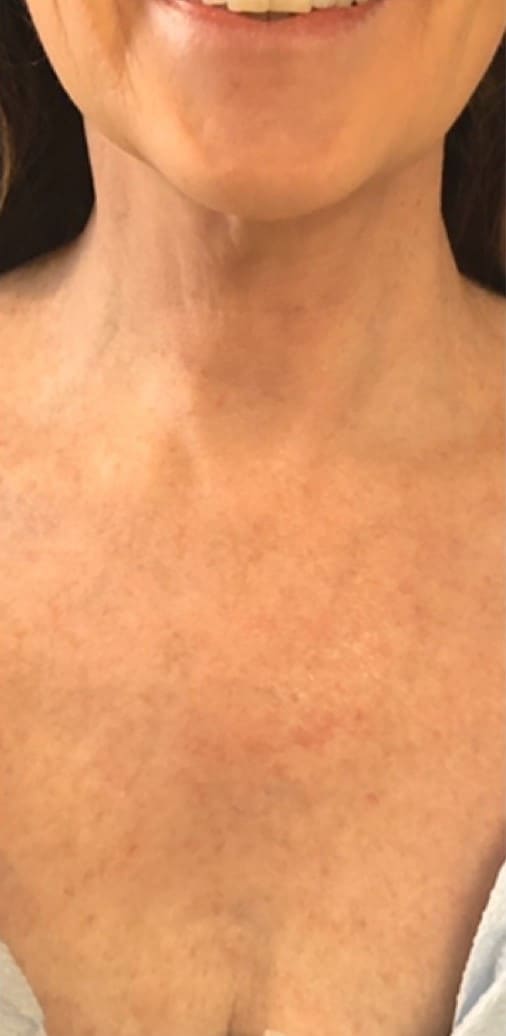 After - Bra & back fat reduction