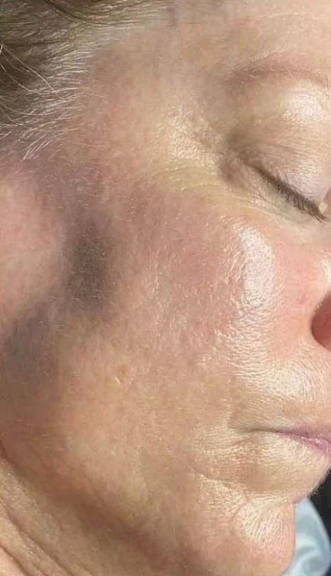 After - Significant pigmentation