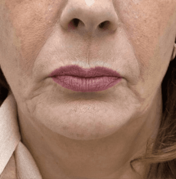 Before anti-ageing treatment
