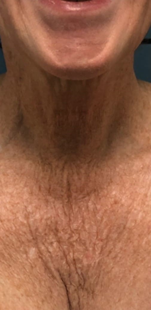 Before - Bra & back fat reduction