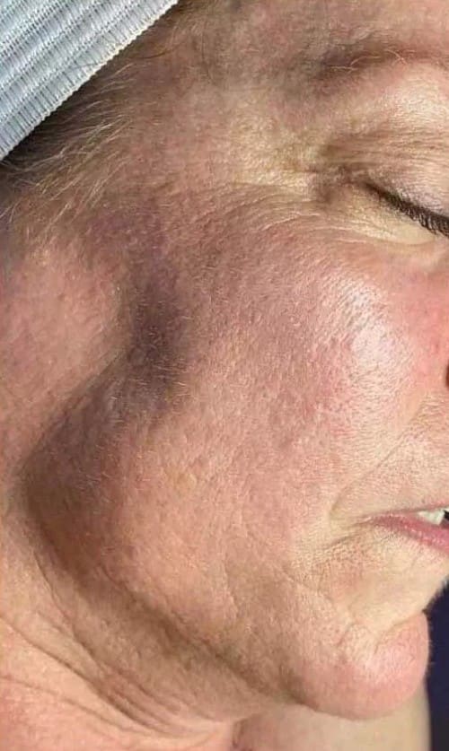 Before - Significant pigmentation